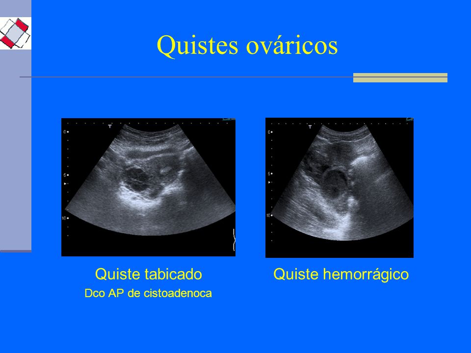 Dolor abdominal quiste ovario